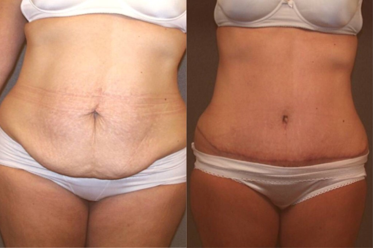 tummy tuck before and after, liposuction, cavitation