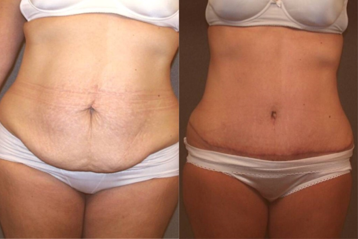 tummy tuck before and after