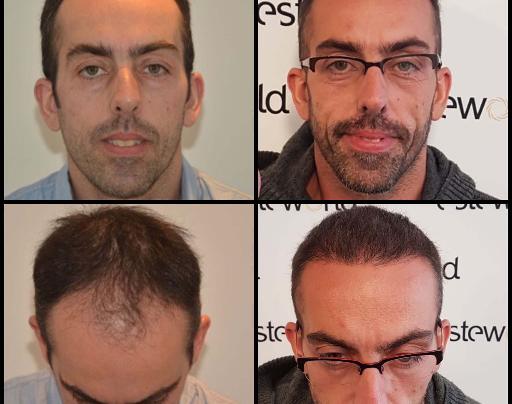 haar inplanten DrBeckmann