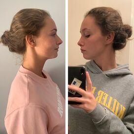 Marielle, voor een neuscorrectie moet je bij Esteworld zijn.