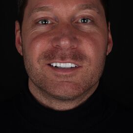 Via 3 vrienden bij Esteworld voor facings en kronen