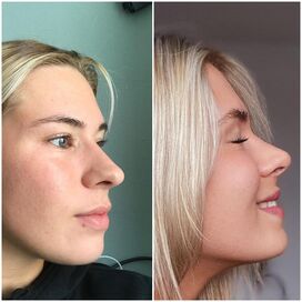 Beste keuze ooit geweest! Blij met mijn Neus!