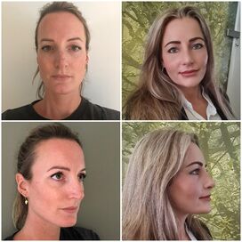 Esteworld bedankt voor mijn nieuwe neus!