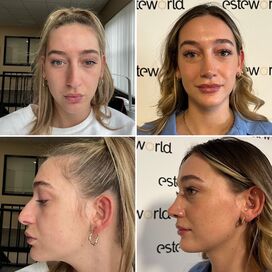 Ik droomde al van een neuscorrectie