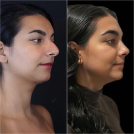 Neus en borstcorrectie voor Nicole