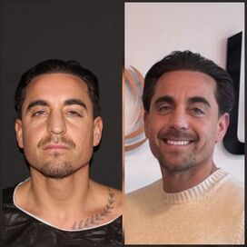 Martin, een neuscorrectie wilde ik al zo lang