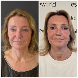 Facelift, Ik ben een vrouw van 60 met geest van 30