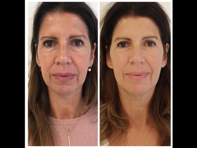 Scarlet-S (facelift zonder operatie)