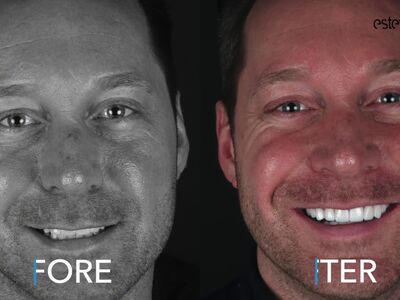 Via 3 vrienden bij Esteworld voor facings en kronen