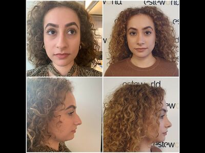 Betul super blij met neuscorrectie