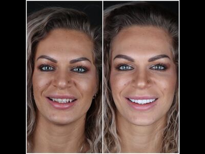 @EvelienNellen voor kronen en facings naar Turkije