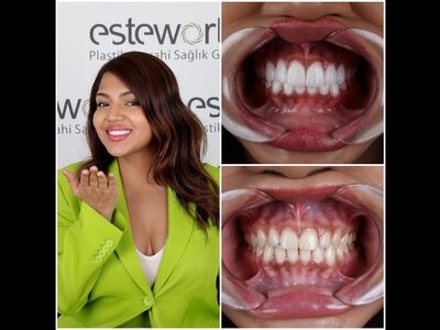 Gebits-makeover Istanbul