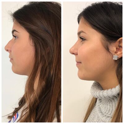 Had ik neuscorrectie maar eerder gedaan!