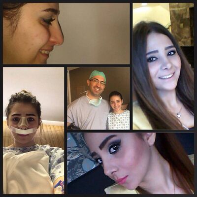 Aida voor haar neuscorrectie naar Turkije.