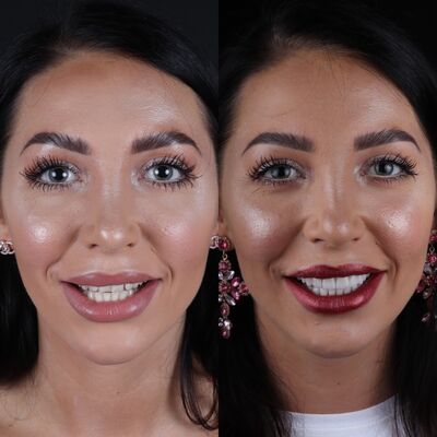 Adrianna een nieuwe lach