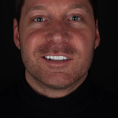 Via 3 vrienden bij Esteworld voor facings en kronen