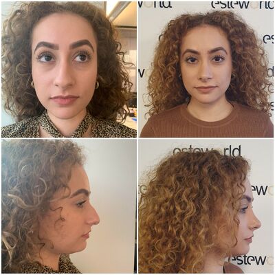 Betul super blij met neuscorrectie