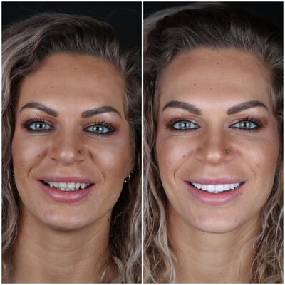 @EvelienNellen voor kronen en facings naar Turkije