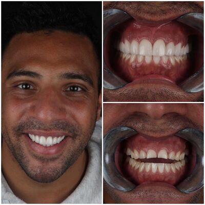 Kronen en facings Turkije samen met tante en moeder.