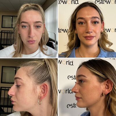 Ik droomde al van een neuscorrectie