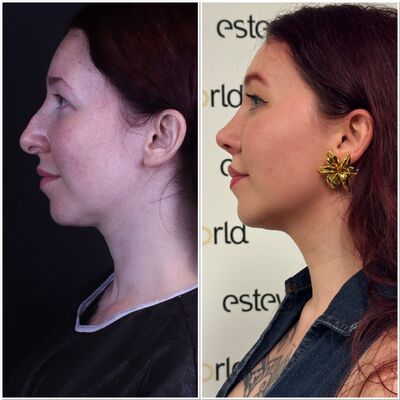 Neuscorrectie van @Eslunalove