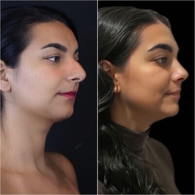 Neus en borstcorrectie voor Nicole