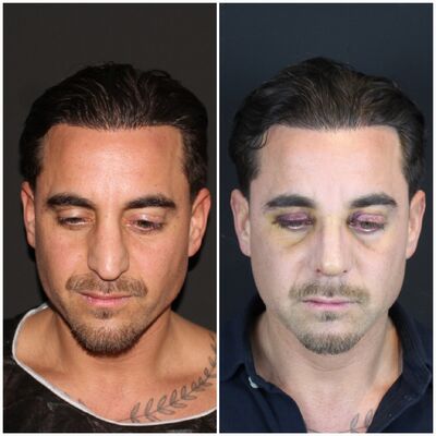 Martin, een neuscorrectie wilde ik al zo lang