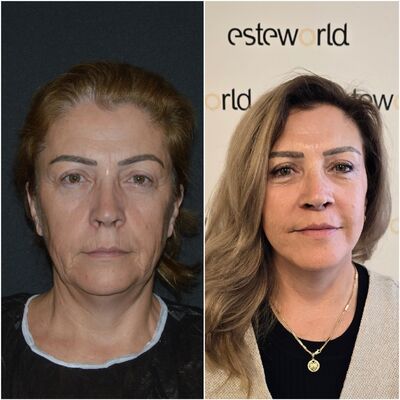 Sedette, zo happy met mijn natuurlijke facelift