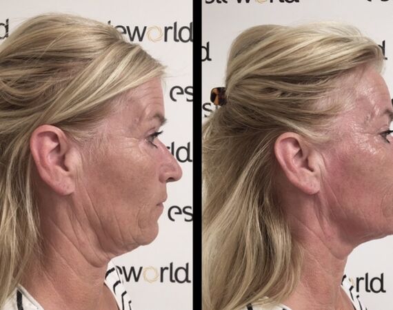 Scarlet-S (facelift zonder operatie)