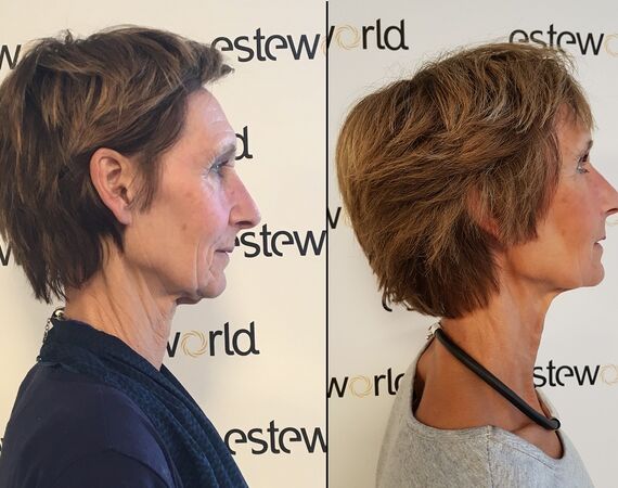 Scarlet-S (facelift zonder operatie)