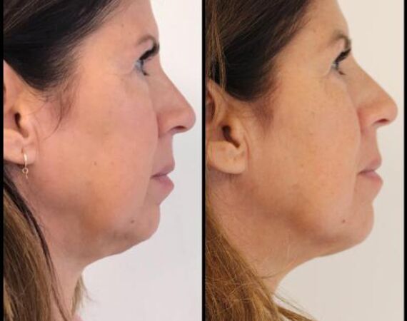 Scarlet-S (facelift zonder operatie)