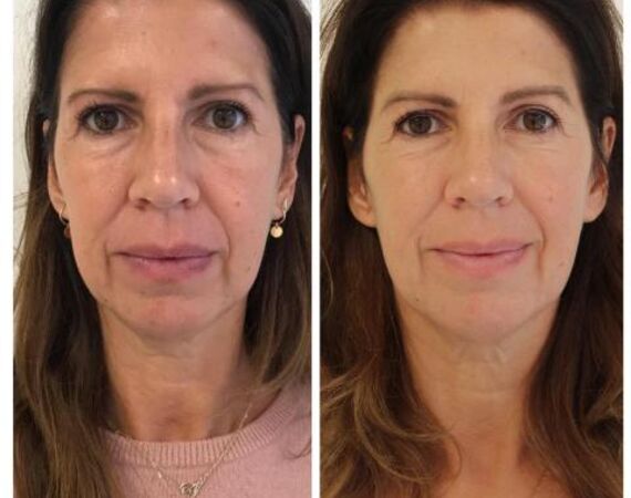 Scarlet-S (facelift zonder operatie)