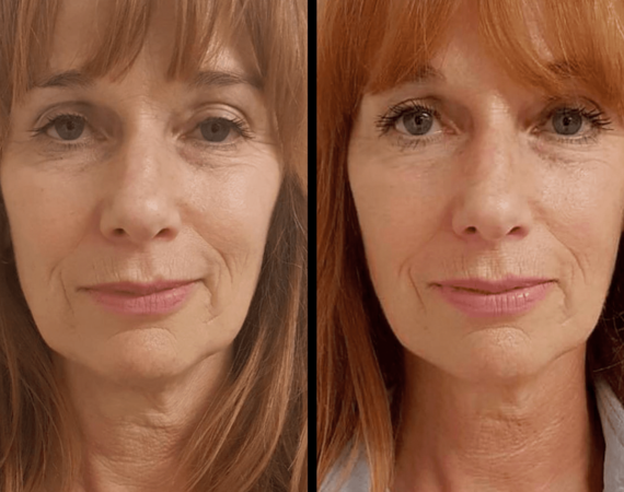 Scarlet-S (facelift zonder operatie)