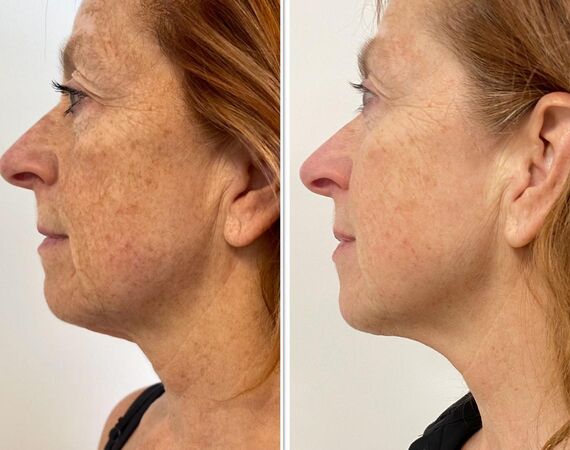 Scarlet-S (facelift zonder operatie)