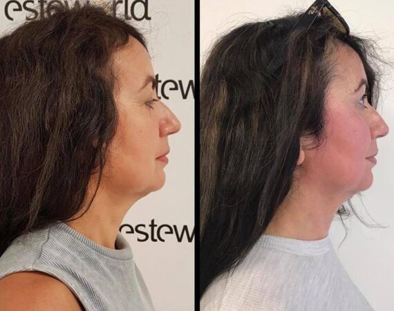 Scarlet-S (facelift zonder operatie)