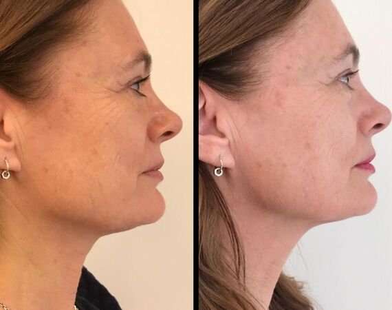 Scarlet-S (facelift zonder operatie)