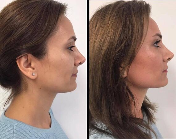 Scarlet-S (facelift zonder operatie)