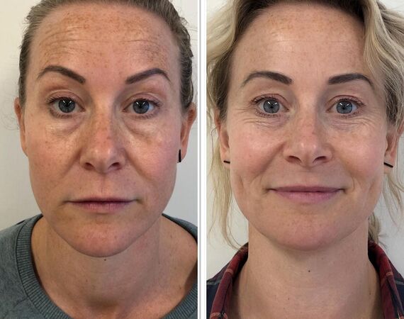 Scarlet-S (facelift zonder operatie)