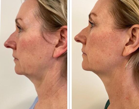 Scarlet-S (facelift zonder operatie)