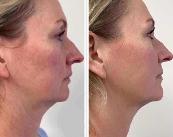 Scarlet-S (facelift zonder operatie)