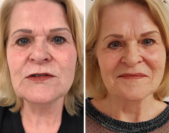 Scarlet-S (facelift zonder operatie)