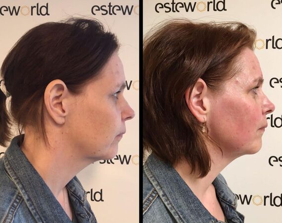 Scarlet-S (facelift zonder operatie)