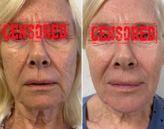 Scarlet-S (facelift zonder operatie)