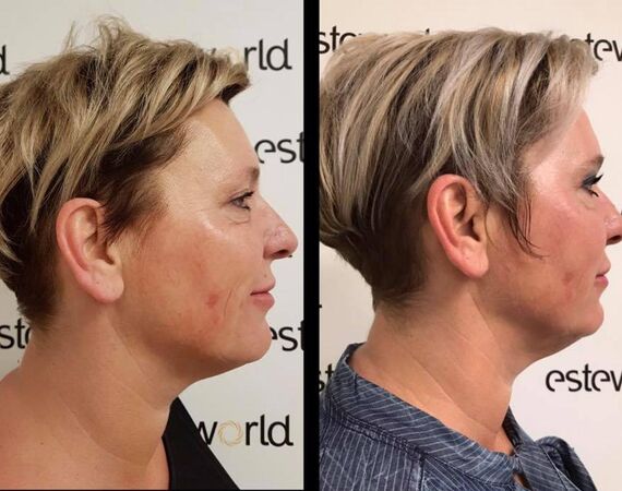 Scarlet-S (facelift zonder operatie)