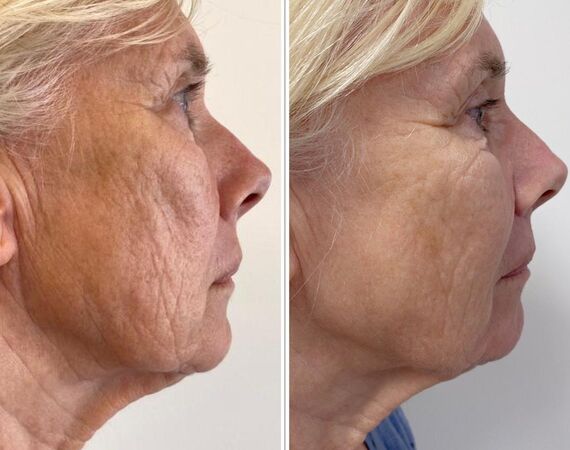 Scarlet-S (facelift zonder operatie)