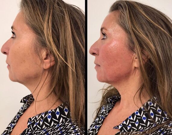 Scarlet-S (facelift zonder operatie)