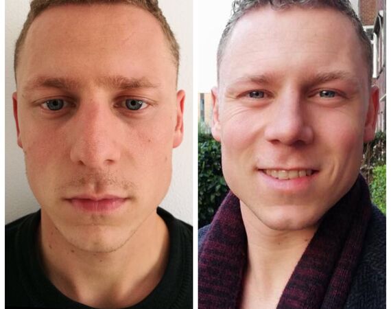 Neuscorrectie Turkije