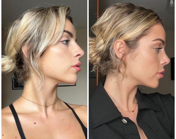 Neuscorrectie Turkije