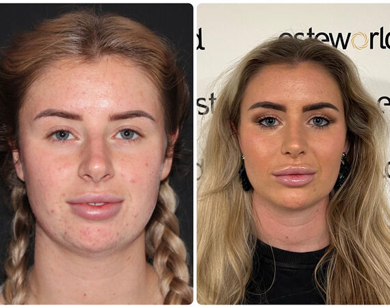 Neuscorrectie Turkije