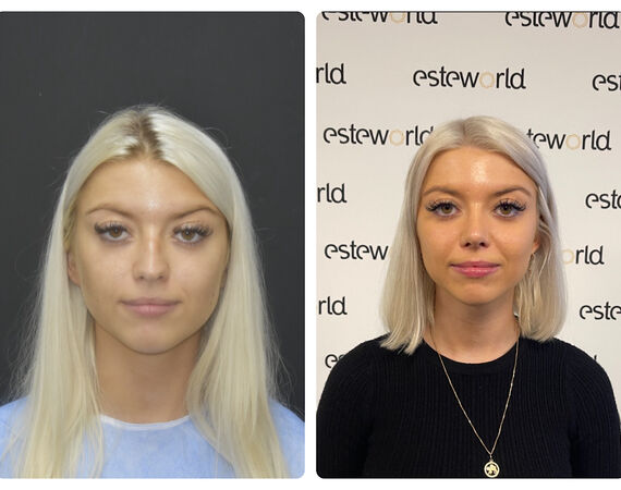 Neuscorrectie Turkije